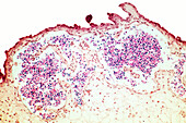 Nucleated RBCs in placental, LM