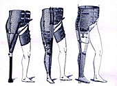 Advances in prosthetic legs, illustration