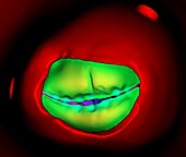 Bicuspid aortic valve, 3D CT-based illustration