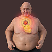 Obese man with ascending aortic aneurysm, illustration