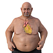Overweight man with obese heart, illustration