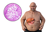 Overweight man with liver steatosis, illustration