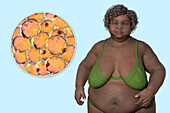 Overweight woman and adipocytes, illustration