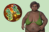Overweight woman and adipocytes, illustration
