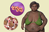 Overweight woman and adipocytes, illustration