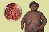 Overweight woman and digestive system, illustration
