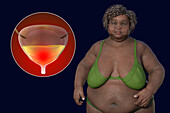 Senior overweight woman and urinary bladder, illustration