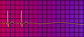 Asystole cardiac arrest, illustration