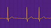 Atrial fibrillation irregular heartbeat rhythm, illustration