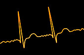 Atrial fibrillation irregular heartbeat rhythm, illustration