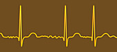 Atrial fibrillation irregular heartbeat rhythm, illustration