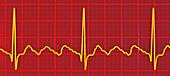 Atrial flutter abnormal heartbeat rhythm, illustration