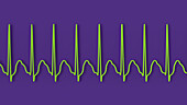 Atrial flutter abnormal heartbeat rhythm, illustration