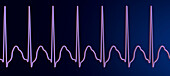 Supraventricular tachycardia heartbeat rhythm, illustration