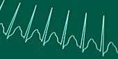 Supraventricular tachycardia heartbeat rhythm, illustration