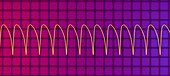 Ventricular tachycardia heartbeat rhythm, illustration