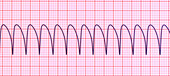 Ventricular tachycardia heartbeat rhythm, illustration