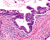 Adenocarcinoma of the colon, light micrograph
