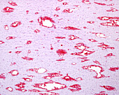Cerebral microhaemorrhages, light micrograph