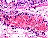 Inflammation in leukocyte diapedesis, light micrograph