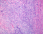 Uterine sarcoma, light micrograph