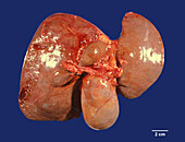 Mucocele of gallbladder