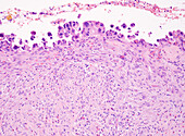 Gallbladder dysplasia, light micrograph