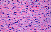 Reactive fibroblast cells, light micrograph