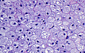 Foamy histiocytes, light micrograph