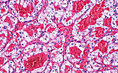 Clear cell kidney cancer, light micrograph