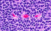 Adult granulosa cell tumour, light micrograph