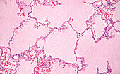 Pulmonary oedema, light micrograph