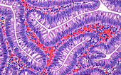 Tubular adenoma, light micrograph