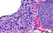 Urothelial carcinoma in situ, light micrograph
