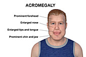 Acromegaly in a man, illustration