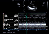 Cardiac output, ulstrasound scan