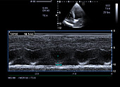 Tricuspid annular plane systolic excursion, ultrasound scan