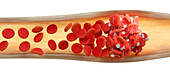 Blood clot, illustration