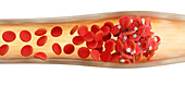 Blood clot, illustration