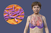Woman with apical tuberculosis, illustration
