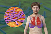 Woman with lung miliary tuberculosis, illustration