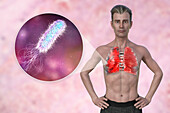 Man with lungs affected by pneumonia, illustration