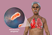 Man with lungs affected by pneumonia, illustration