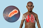 Man with lungs affected by pneumonia, illustration