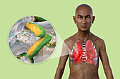 Man with lungs affected by pneumonia, illustration