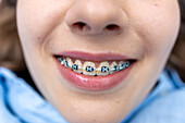 Detailed view of mouth braces smile of a young female with blue shirt.