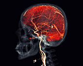 Brain and neck arteries, CT angiogram