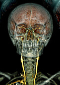 Brain and neck arteries, CT angiogram