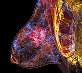 Breast cancer, combined MRI and CT scans