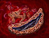 Sickle cell anaemia, illustration